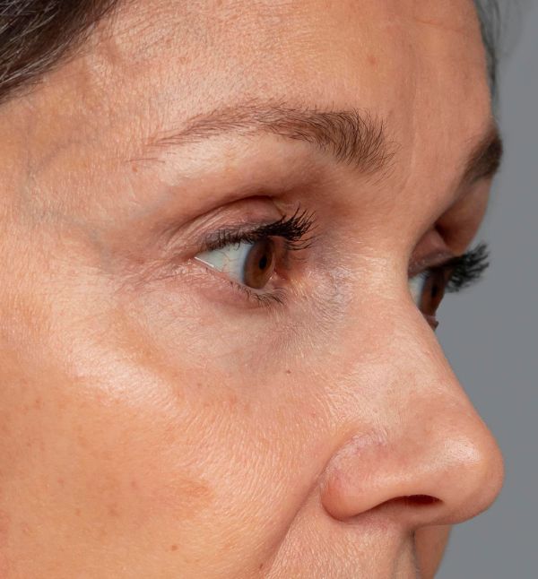 Before-facetwo